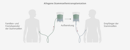 Ablauf einer allogenen Stammzelltransplantation: die Patientin bzw. der Patient erhält fremde Stammzellen 